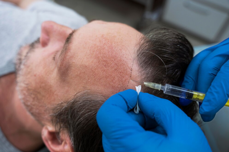 Mesotherapy for Hair