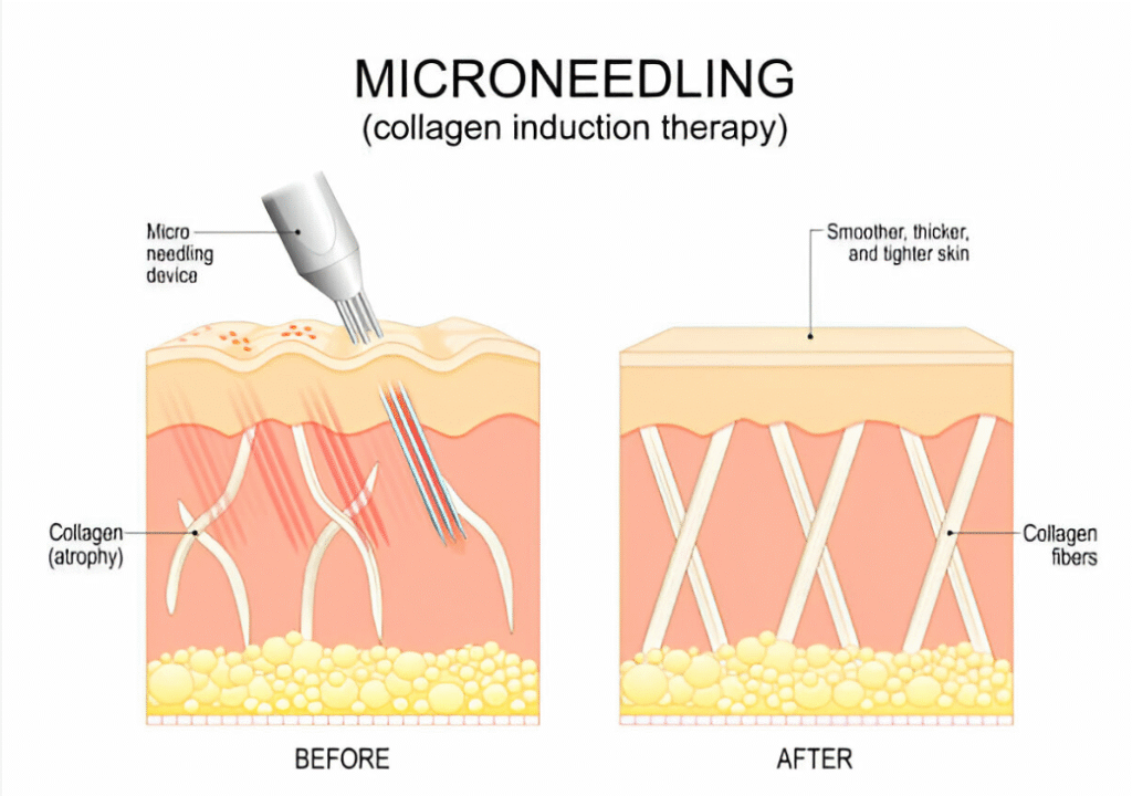 Microneedling