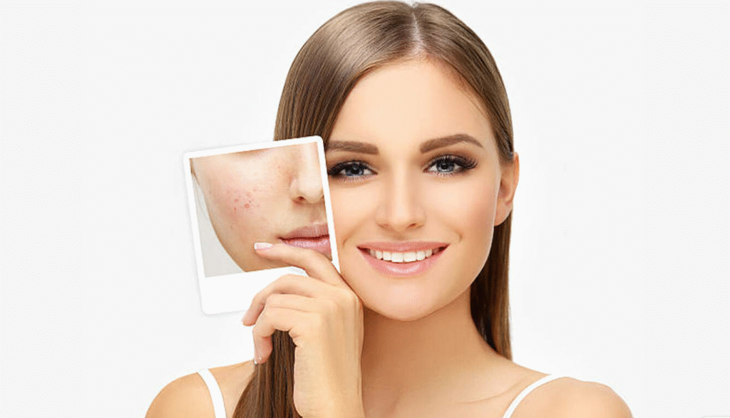 Acne Scar Treatments