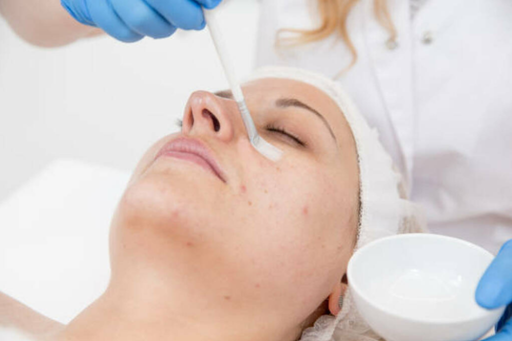 Chemical Peel treatment