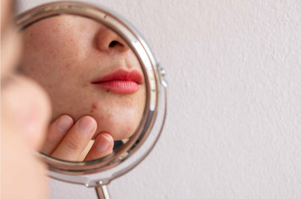 acne scars treatment