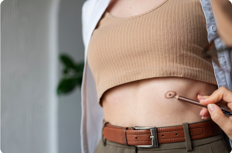 Skin Tag Removal Treatments in Noida