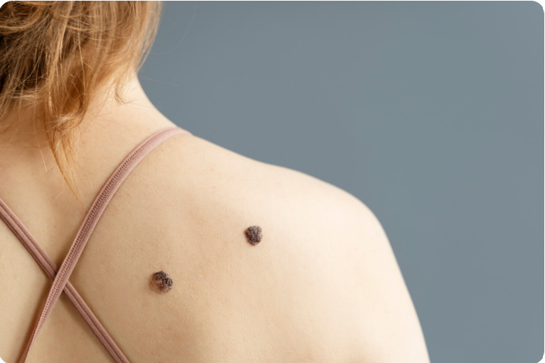 Wart Treatment in Noida