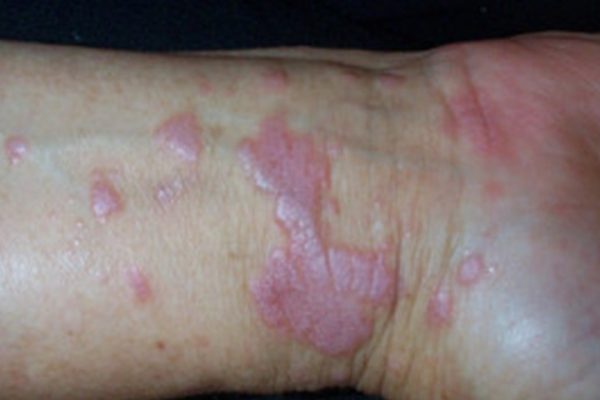 lichen-planus-1